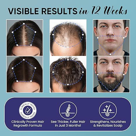🔥Limited-Time 50% Off🔥 |Spray Hair Regrowth Treatment Serum with Biotin