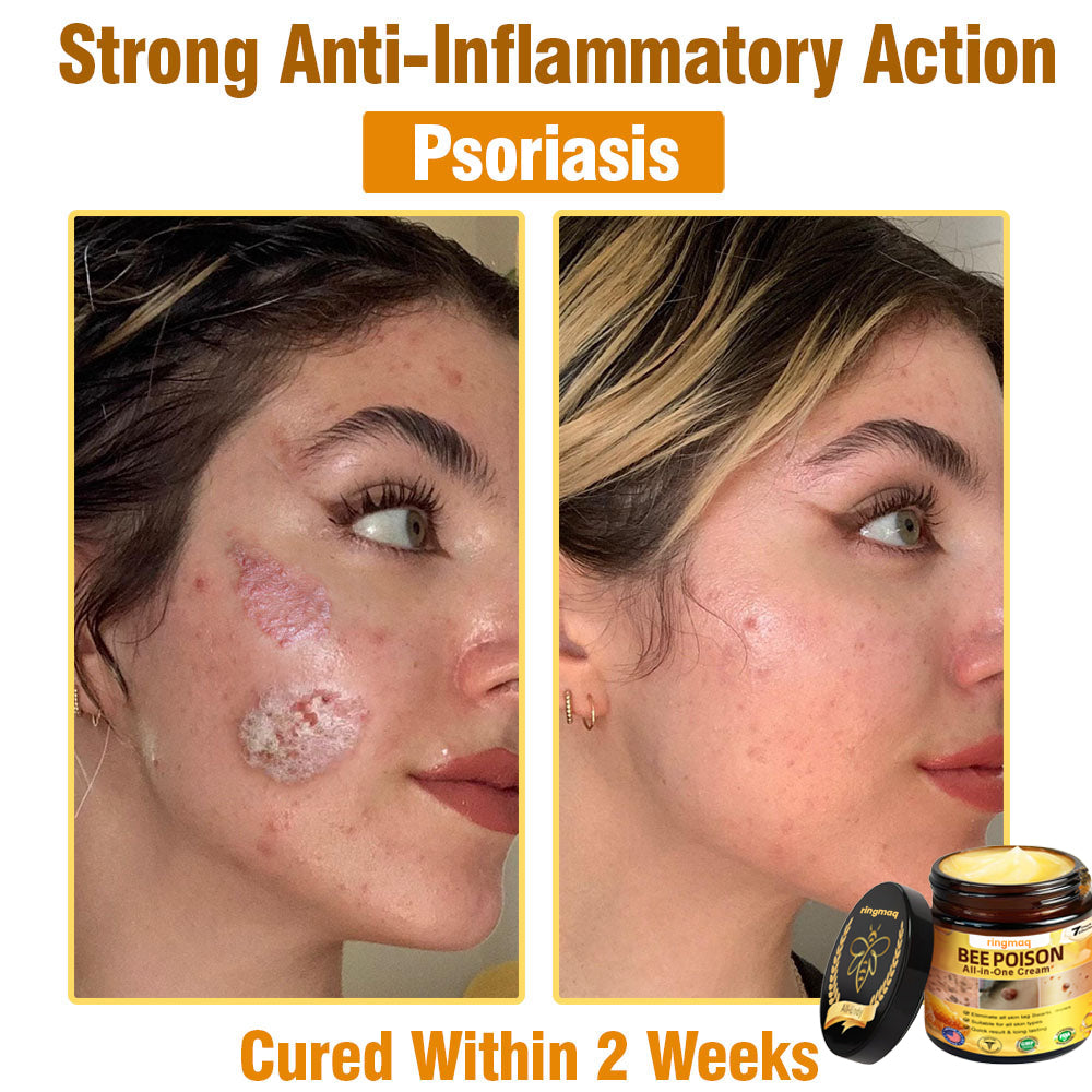 ringmaq Bee Poison All-in-One Cream US Dermatologist Approved