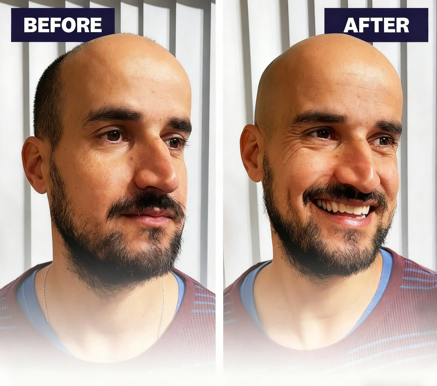🔥50% off limited-time sale🔥 |Effortless Head Shaving: Must-Have Shaver For Bald Guys