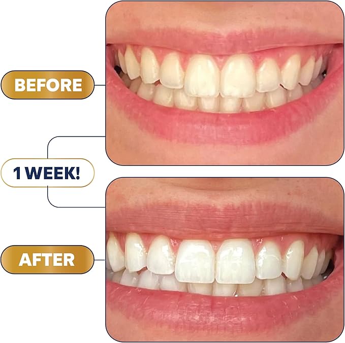 Teeth Whitening Strips