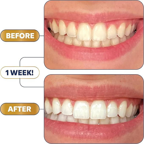 Teeth Whitening Strips