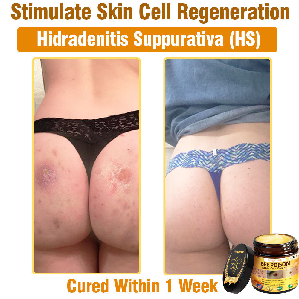 ringmaq Bee Poison All-in-One Cream US Dermatologist Approved