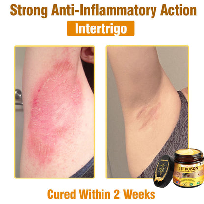 ringmaq Bee Poison All-in-One Cream US Dermatologist Approved