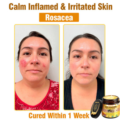 ringmaq Bee Poison All-in-One Cream US Dermatologist Approved
