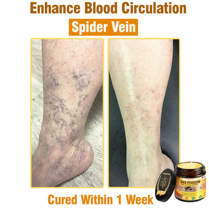 ringmaq Bee Poison All-in-One Cream US Dermatologist Approved