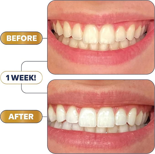 Teeth Whitening Strips
