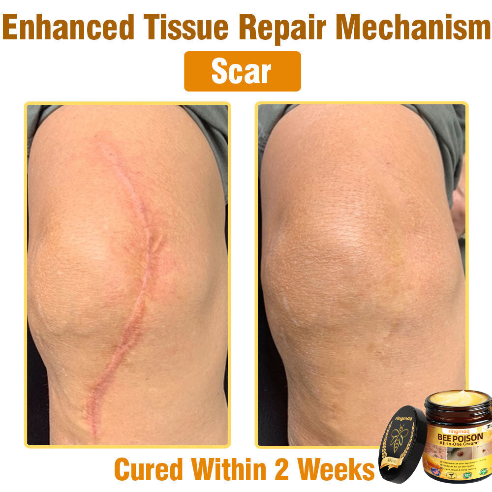 ringmaq Bee Poison All-in-One Cream US Dermatologist Approved